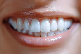 After Teeth Whitening